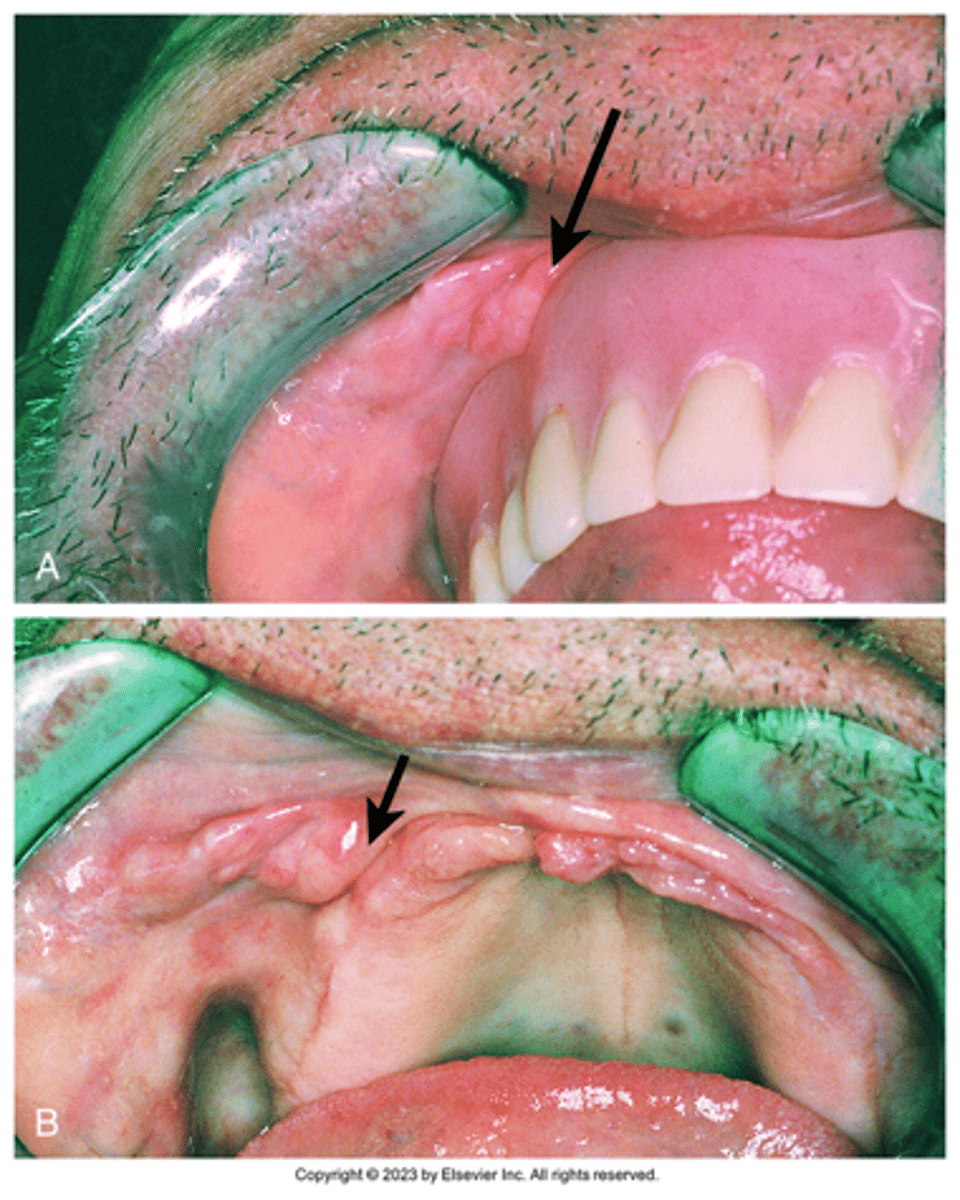 <p>Caused by ill-fitting denture; Usually seen in vestibule due to denture flange</p><p><span>These elongated folds of tissue composed of dense, fibrous connective tissue form as a result of an ill-fitting full or partial denture. What is your DHDx?</span></p>