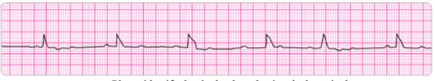 <p>Identify the rhythm.</p>