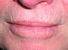 <p>Se pierde el borde entre los labios y la piel; es característico de esclerodermia</p>