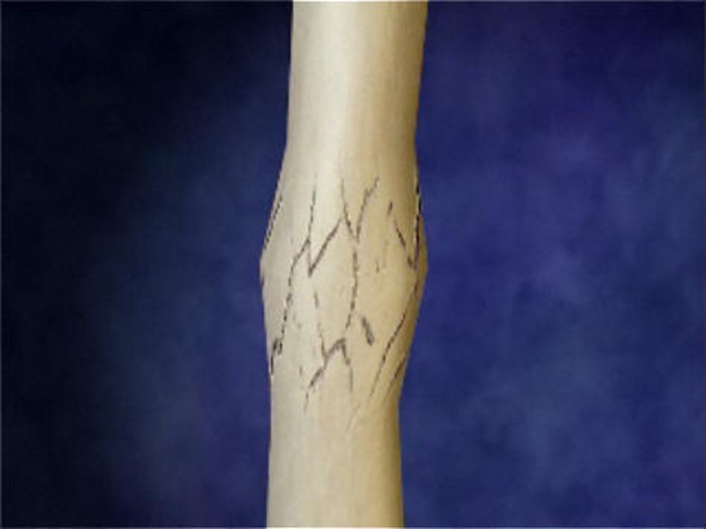 <p>one fragment driven into another</p>