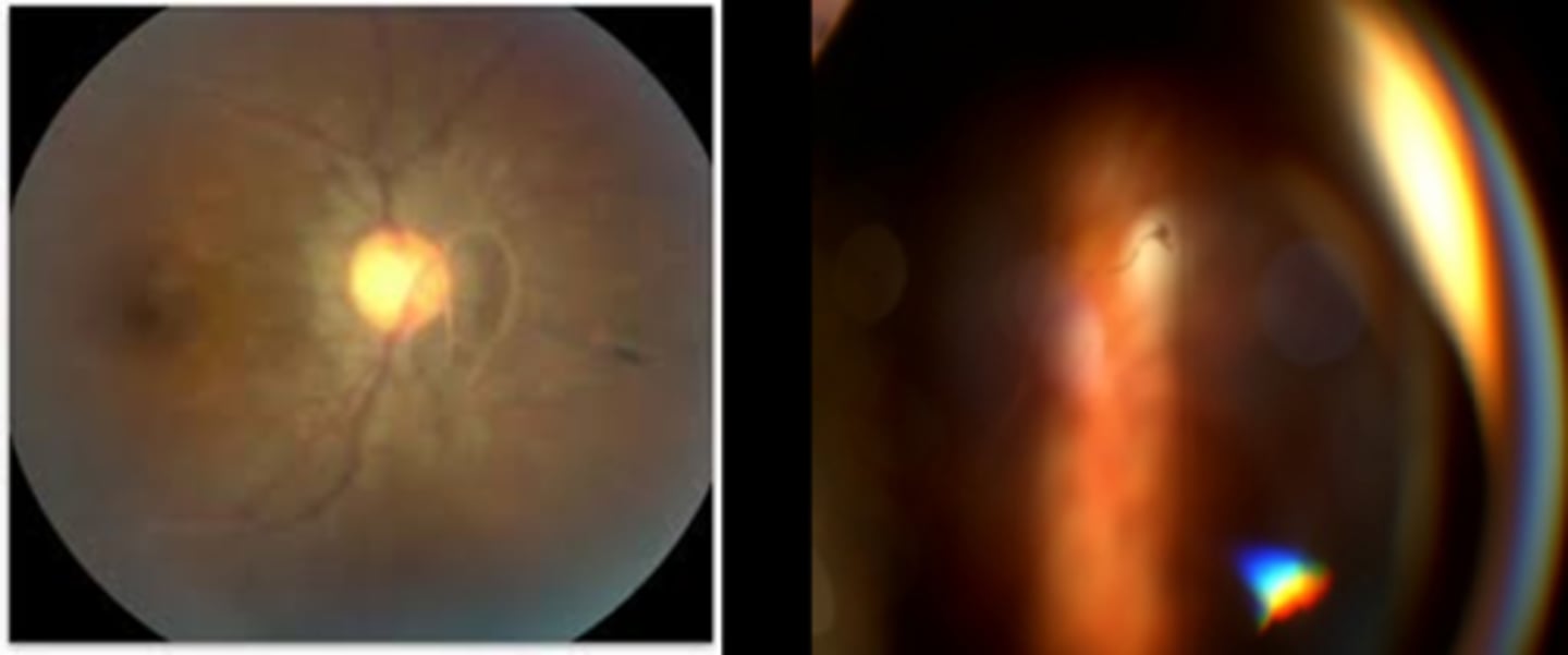 <p>Weiss ring = dense peripapillary glial tissue still attached to posterior vitreous but no longer attached to ONH = complete PVD</p>
