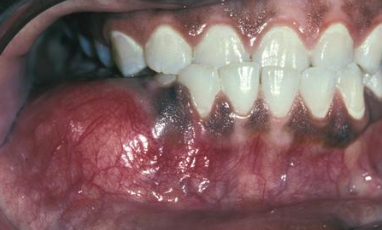 <p><strong>Mandible</strong> &gt; maxilla</p>