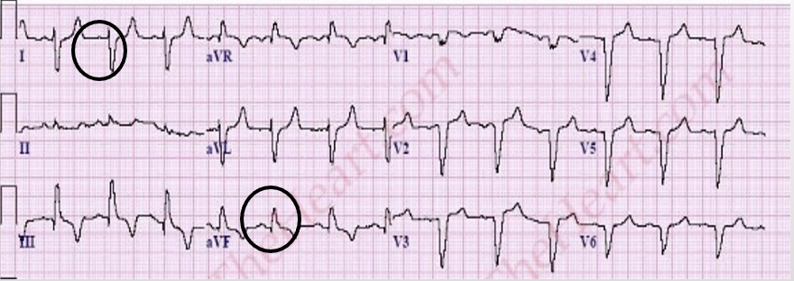 <p>Lead I is negatively deflected, but aVF is positively deflected</p>