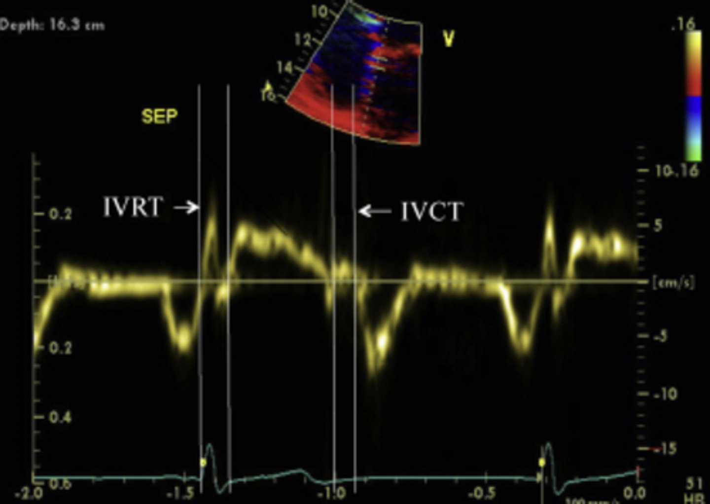 <p>Measures peak & mean velocities in systole (Sa/Sm), early diastole (Ea/Em), and end diastole (Aa/Am).</p><p>Systole - Annulus descending</p><p>Early diastole - annulus ascends (away from apex)</p><p>End diastole - atrial contraction</p>