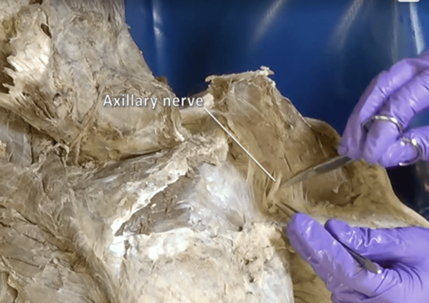 <p>deltoid and teres minor</p>