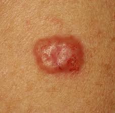 <p>least malignant,  most common type, comes from stratum basal</p>