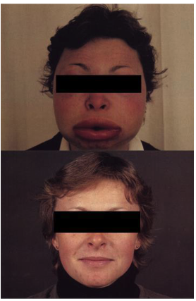 <p>rare autosomal dominant genetic disorder resulting from an inherited deficiency or dysfunction of C1-INH (C1 inhibitor)</p>