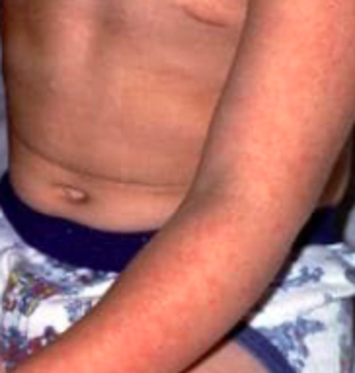 <p>Exanthems:</p><p>Overview:</p><p>“5th disease”</p><p>- Due to human parvovirus (PV) B19</p><p>- Classic slapped-cheek appearance and lazy exanthem</p><p>Incubation: 4-14 days</p><p>- Spread by respiratory droplets, blood products, or mother → fetus</p>