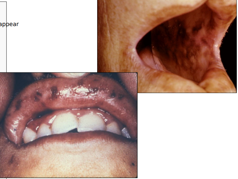 <p><span>a brown pigmentation that can can be on the lips intra orally and on the skin;</span> more of that bronze color</p>