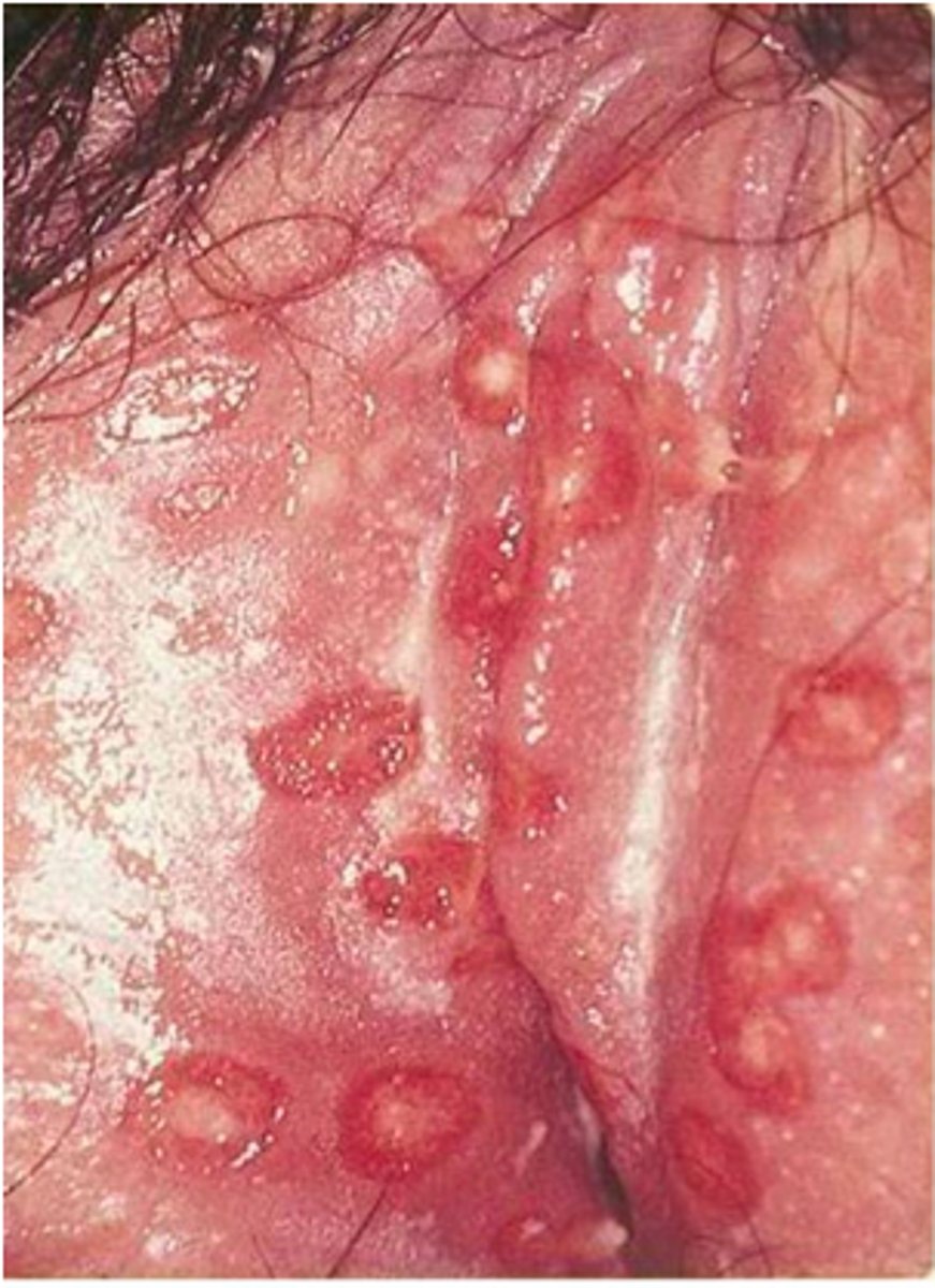 <p>Men = blisters/sores; flu symptoms; or none</p><p>Women = blisters/sores; flu symptoms; or none</p>