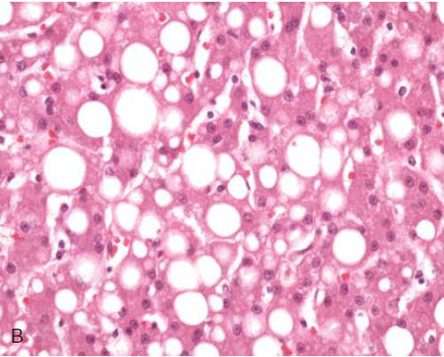 <p>histological image of what cellular injury?</p>