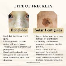 <p>E: sun-exposed areas<br>young children<br>genetics</p><p>CM: flat brown macules</p>