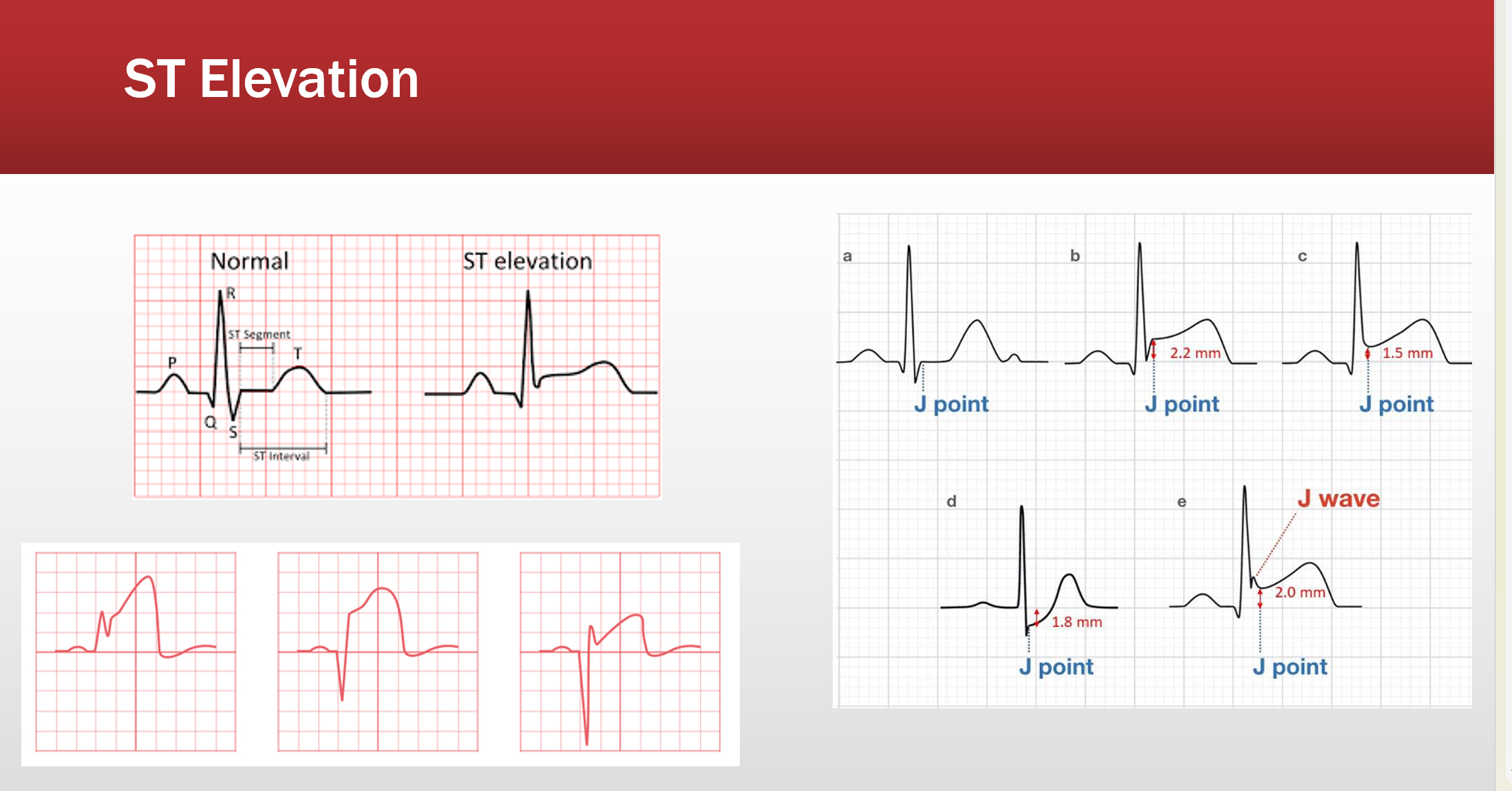 <p>S is higher or lower than Q w/ a J point above or below it’s normal midline</p>