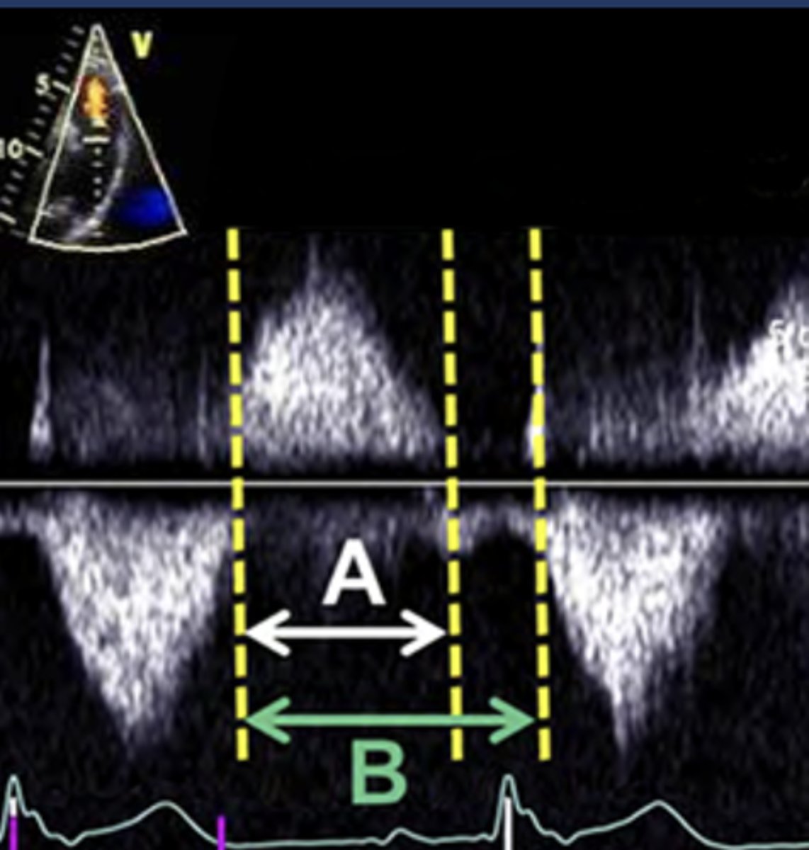 <p>Ratio of PR duration to total diastolic duration</p>