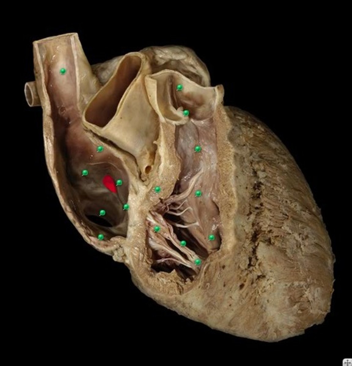 <p>remnant of foramen ovale of fetal heart</p>