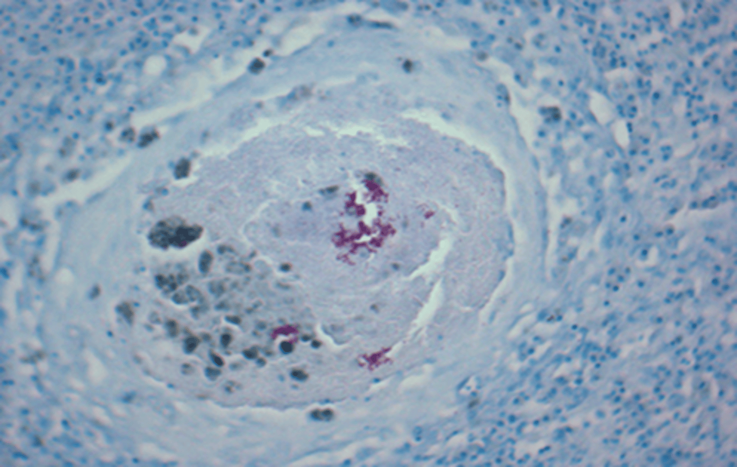 <p>Your colony of zebrafish is experiencing sudden high mortality, with some showing coelomic distension. Histopathology shows organisms that stains positive with Ziehl-Neelson stain. What is the best course of action?</p><p>A. Complete eradication of fish and disinfection of the system</p><p>B. Remove stressors and administer oxytetracycline into the system</p><p>C. Prolonged immersion in copper sulfate</p><p>D. UV sterilization</p><p>E. Salt-water immersion at >3 ppt</p>