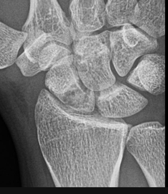 <p>The most common carpal bone fracture that is a result of a FOOSH and leads to pain in the anatomical snuff box dorsally and scaphoid tubercle volarly</p>