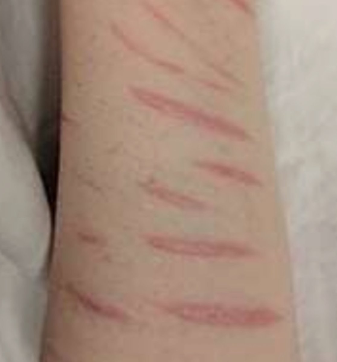 <p>¿lesión?</p><p>¿primaria o secundaria?</p>