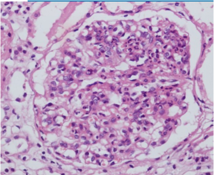 <p>45 year old African American female presents to office with blood in her urine. She has no significant past medical history. Family history reveals sarcoidosis in her mother. Vital signs reveal BP 155/90. Lab studies reveal proteinuria (2.4 g protein), positive anti-double stranded DNA antibodies, and low complement C3 and C4 levels. An US-guided biopsy was performed. A tissue section representative of the remaining tissue is shown in the exhibit. The most likely diagnosis is:</p>