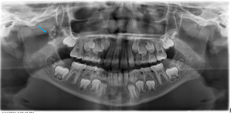 <p>this is pointing to chewing gum, but how can we make sure that this is not something pathological or that it is not a ghost image </p>