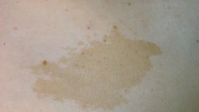 <p>Hyperpigmented lesions that range from light to dark brown, do not go away, but may fade or change shape over time </p>