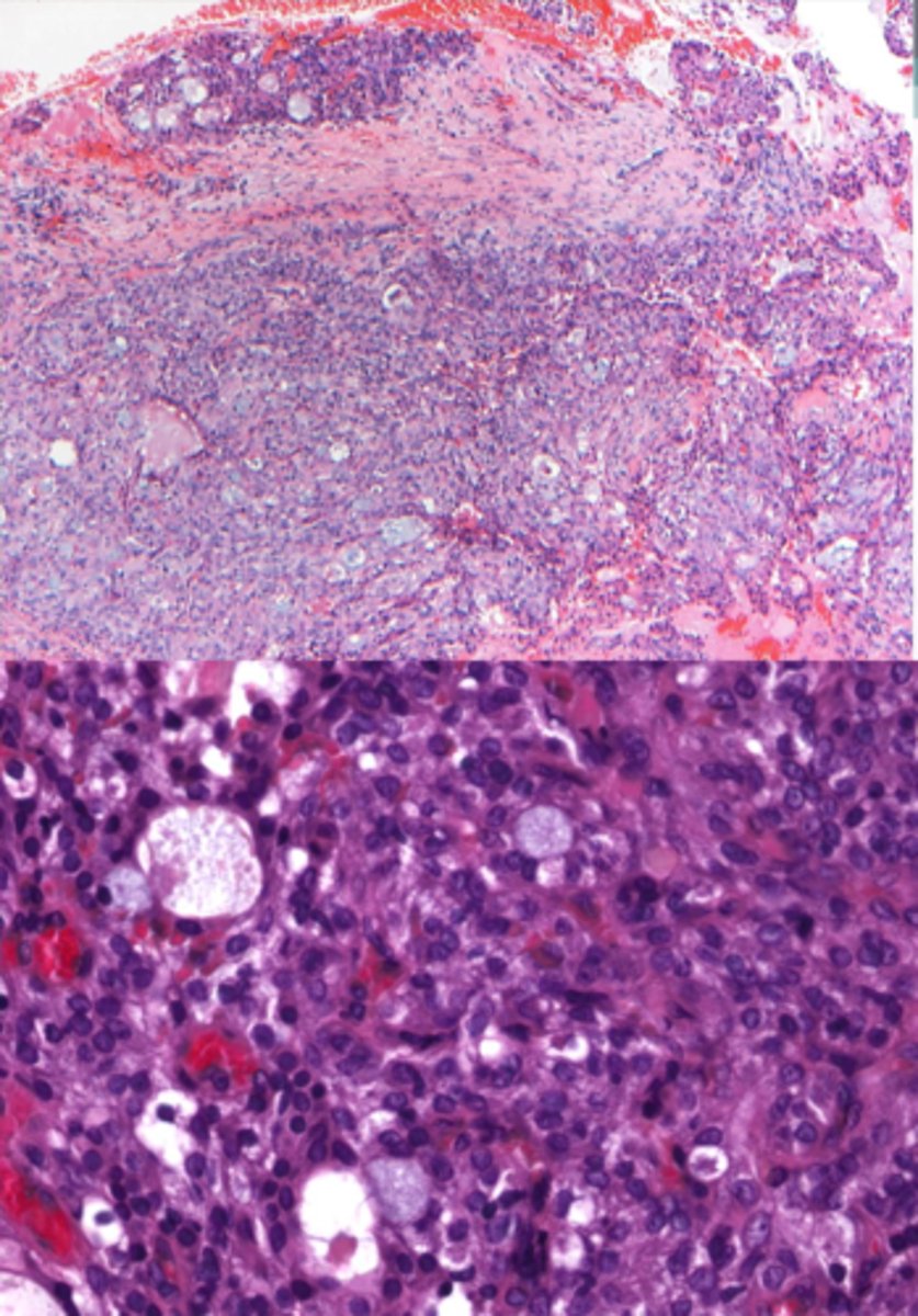 <p>-Epidermoid cells</p><p>-Mucous cells</p><p>-Ductal structures</p><p>-Cystic spaces</p><p>-CRCT1-MAMl2 translocation ⇒ t(11;19)</p>