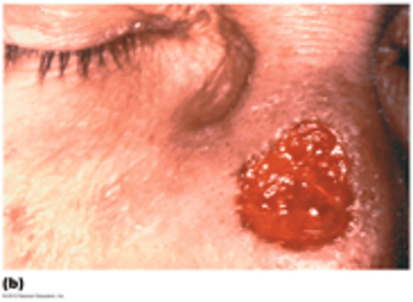 <p>Tertiary Syphilis (T. Pallidum)</p>