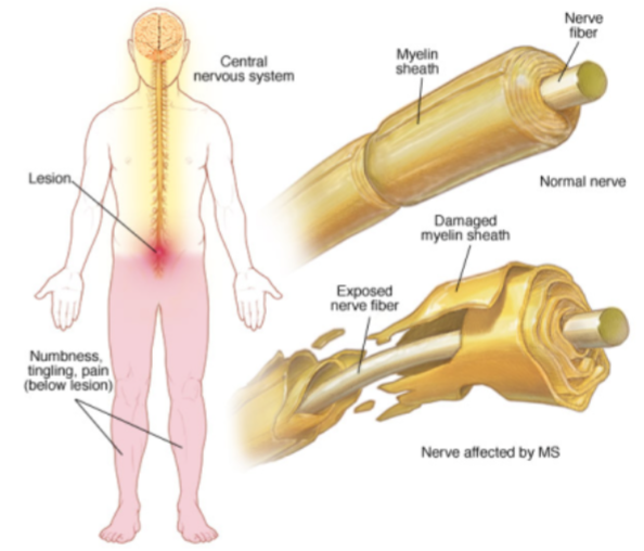 1. Progressive demyelination of neurons in CNS with destruction 
of oligodendrocytes (glia)
2. Interrupts conduction of nerve impulses
3. Inflammation leads to scarring and permanent problems