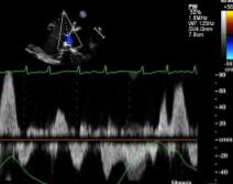 <p>Given this HV PW trace, what would you expect to find when imaging the heart?</p>