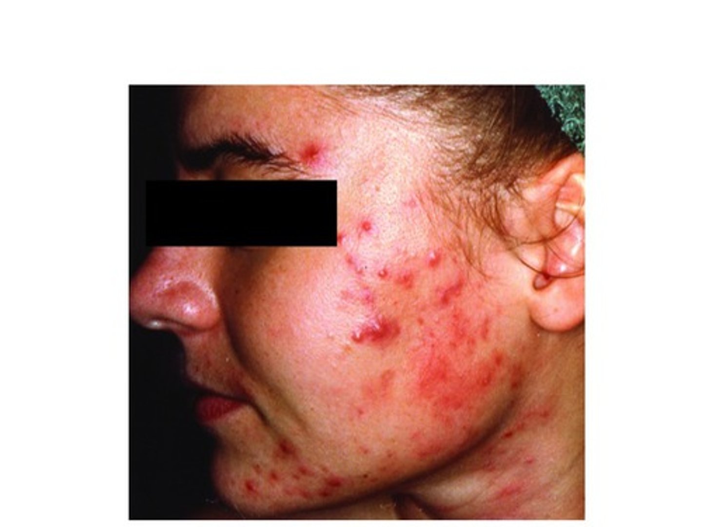 <p>Easily treated with topical formations</p>