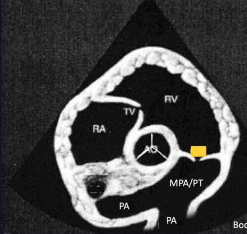 <p>Right Parasternal Short Axis View&nbsp;@ pulmonic valve</p>