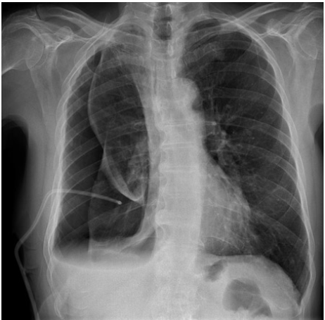 <p>It maintains adequate heart rate and rhythm by delivering electrical impulses. (IMAGE Pneumothorax induced during insertion of pleural drainage catheter)</p>