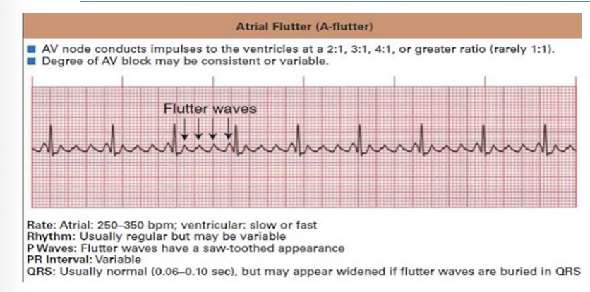 <p>Atrial Flutter:</p><p>NOTICE:</p><ul><li><p>Look for:</p><ul><li><p>Sawtooth Pattern in P Wave</p></li><li><p>QRS Normal</p></li></ul></li><li><p>NO 911/NOT EMERGENCY</p><ul><li><p>MONITOR AND CONTINUE AT LOWER INTENSITY</p></li></ul></li></ul><p></p><p>FLIP</p><p></p>