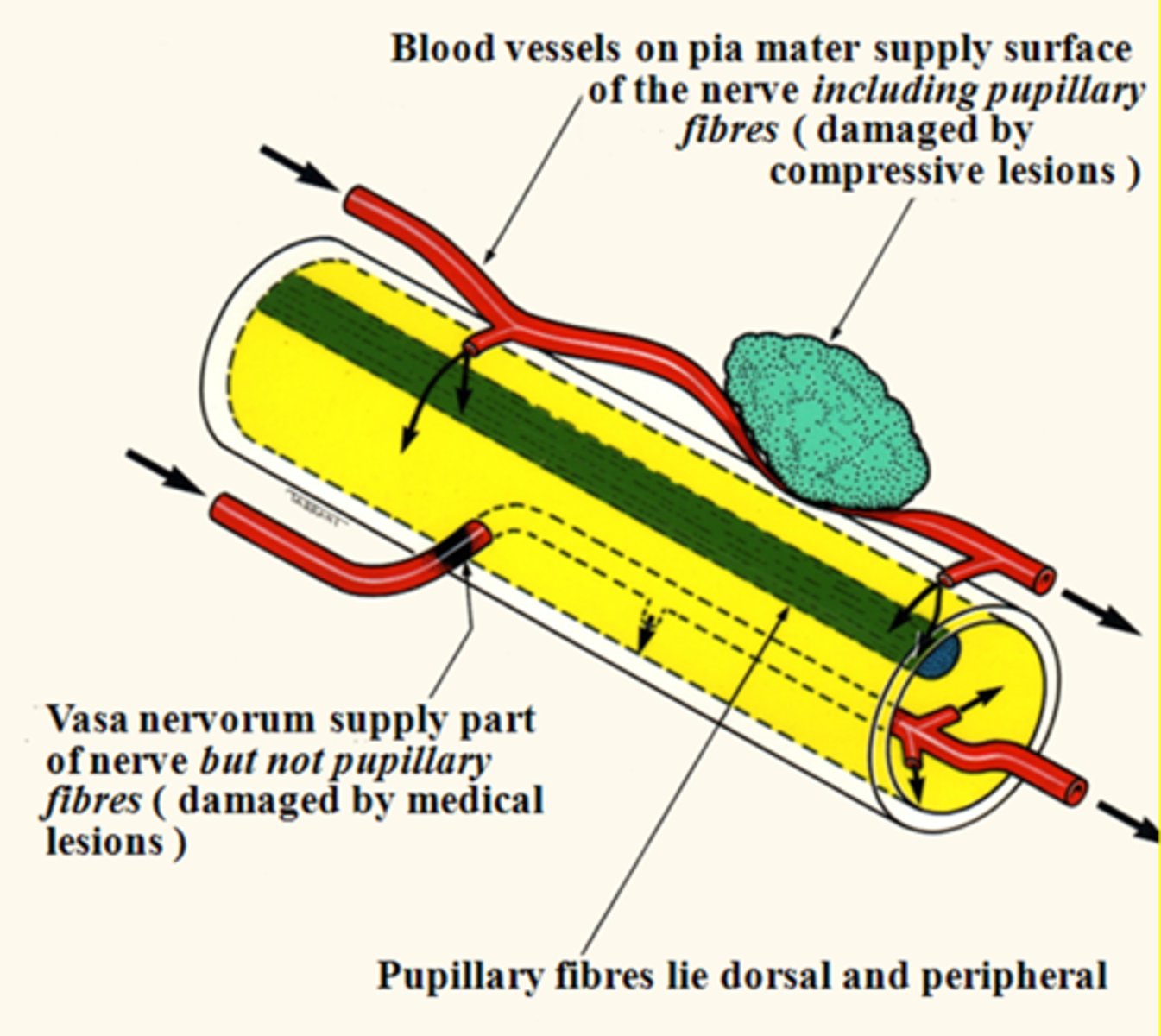 <p>pupillomotor fibers travel around the circumference of CN III</p><p>EOM fibers travel within the core of CN III</p>