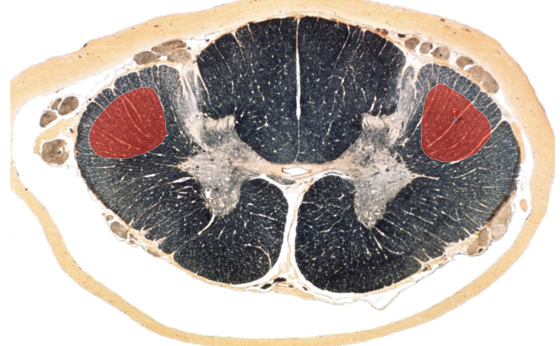 <p><strong>Motor</strong></p><p></p><p>Lateral Corticospinal Tract</p>