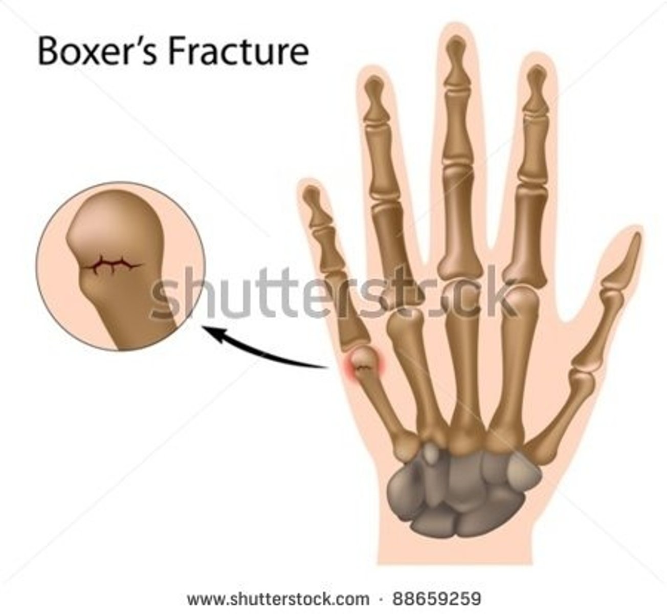 <p>fracture of the distal 5th metacarpal → caused by punching something</p>