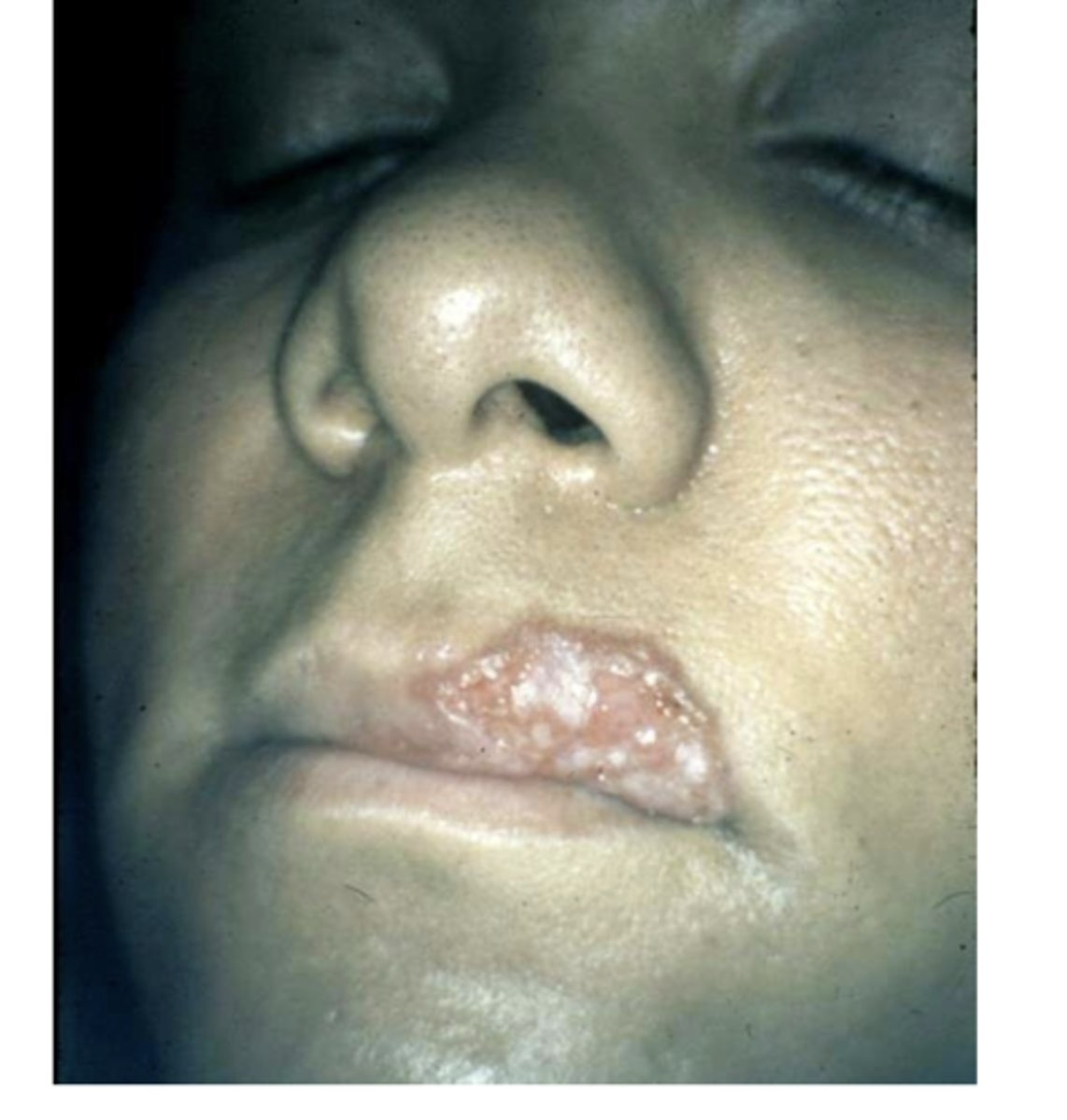 <p>-rare oral lesions --&gt; typically painless ulcers</p><p>-0.5 - 5% of infected patients have clinically evident lesions</p><p>-most cases represent secondary infection</p><p>-rare primary cases</p><p>-bone involvement may be seen</p>