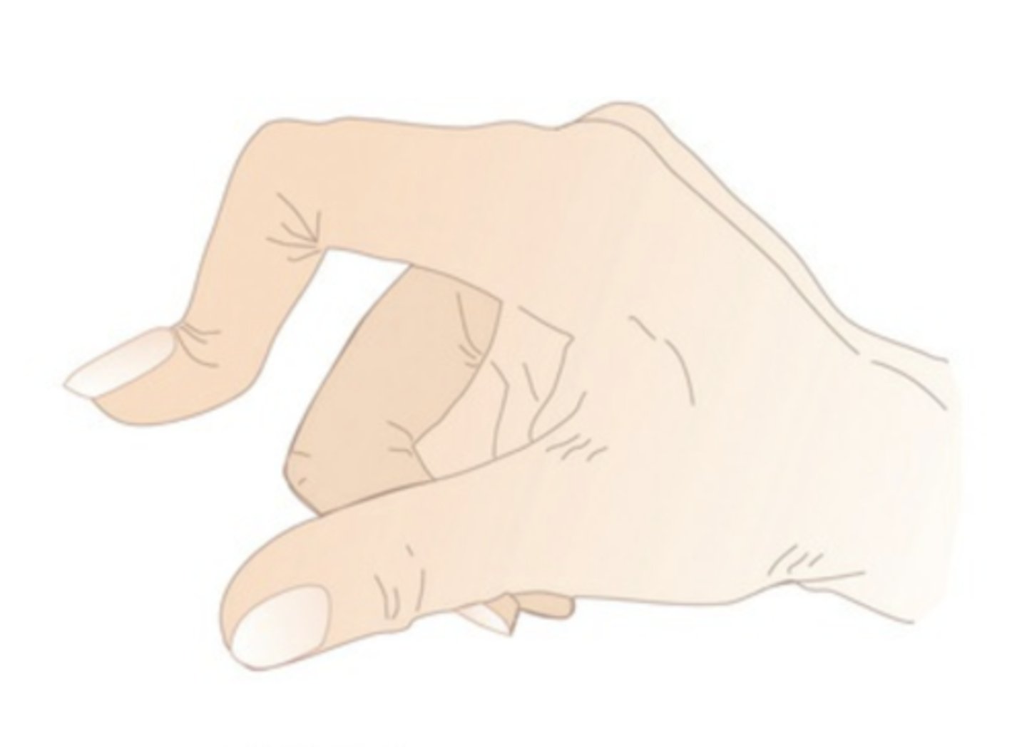 <p>boutonniere deformity</p>