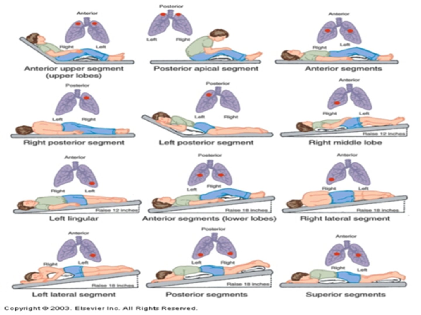 <p>• Percussion, vibration, and postural drainage</p><p>• Loosens and mobilizes secretions</p><p>• Increases mucous clearance</p><p>• Contraindications - head injuries, aspiration risk, children</p><p>with PNA, adults with COPD, postoperative adults</p><p>• Limited evidence for effectiveness</p>