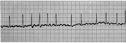 <p><span><span>Irregular atrial signaling <br>(no P wave)</span></span></p><p style="text-align: left;"></p><p style="text-align: left;"><span><span>Decreased CO, increased risk of clotting</span></span></p>