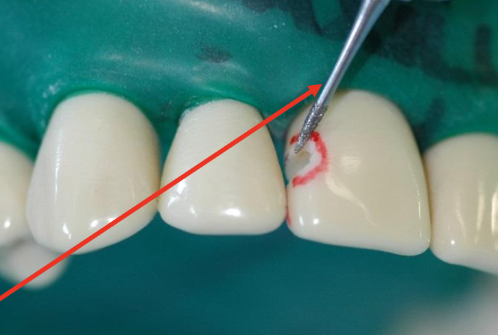 <p>use flame-shaped diamond to create bevel</p><ul><li><p>avoid touching adjacent tooth with diamond by using shorter flame bur</p></li></ul><p></p>