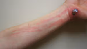 <p>the inflammation in lymphatic system </p><ul><li><p>red streak following the lymphatic system </p><ul><li><p>node willl be tight </p><p></p></li></ul></li></ul><p></p>