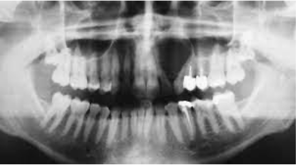 <p>A 31 year old presenting with a cystic swelling in lateral aspect between lateral incisors and canine. Provide differential diagnosis</p>