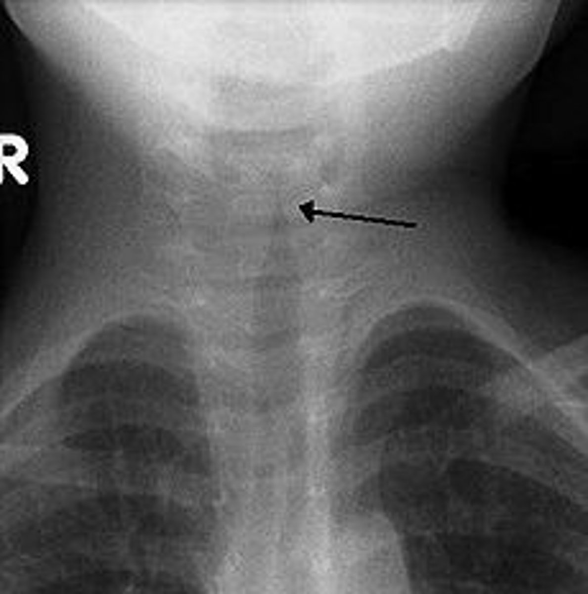 <p>"steeple sign"</p><p>- subglottic airway narrowing at the cricoid cartilage</p>