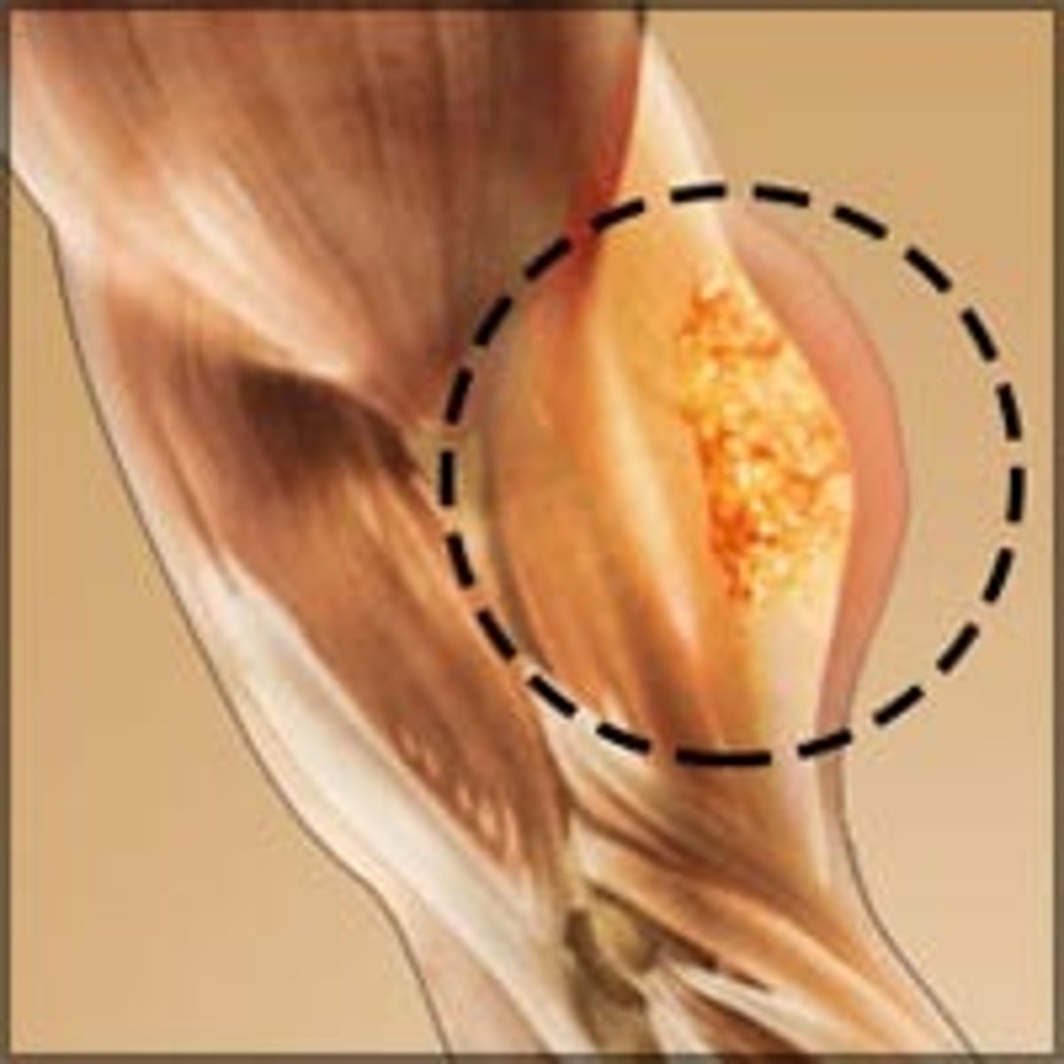 <p>c) Rhabdomyosarcoma</p><p>-Medulloblastoma and retinoblastoma are carcinomas</p><p>-kids ~10 yrs old get rhabdomyosarcomas</p>
