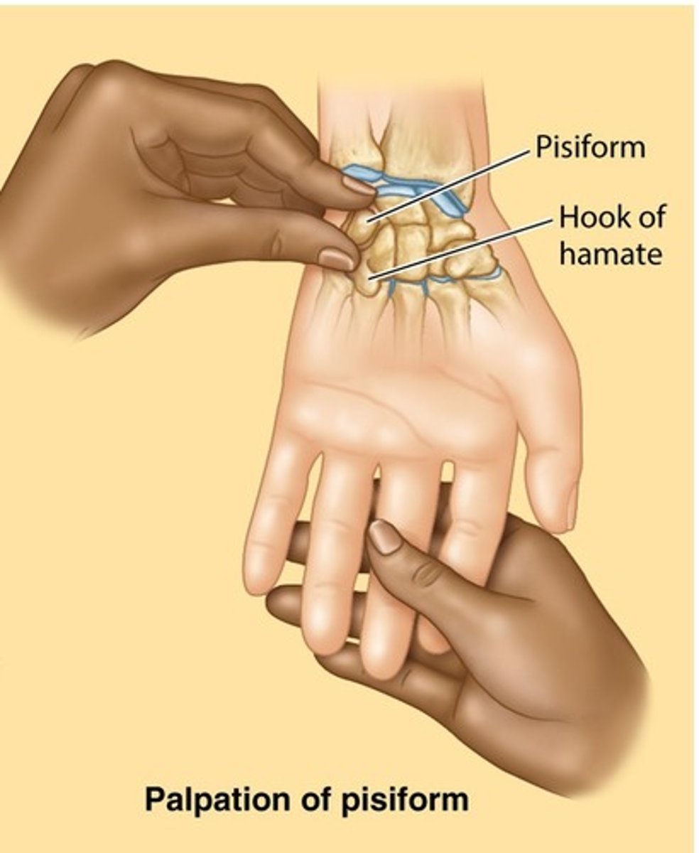 <p>Located at medial base of hand. Sesamoid bone meaning it is inside a tendon.</p><p>Sits on the triquetrum carpal bone. origin of abductor digit minimi.</p>