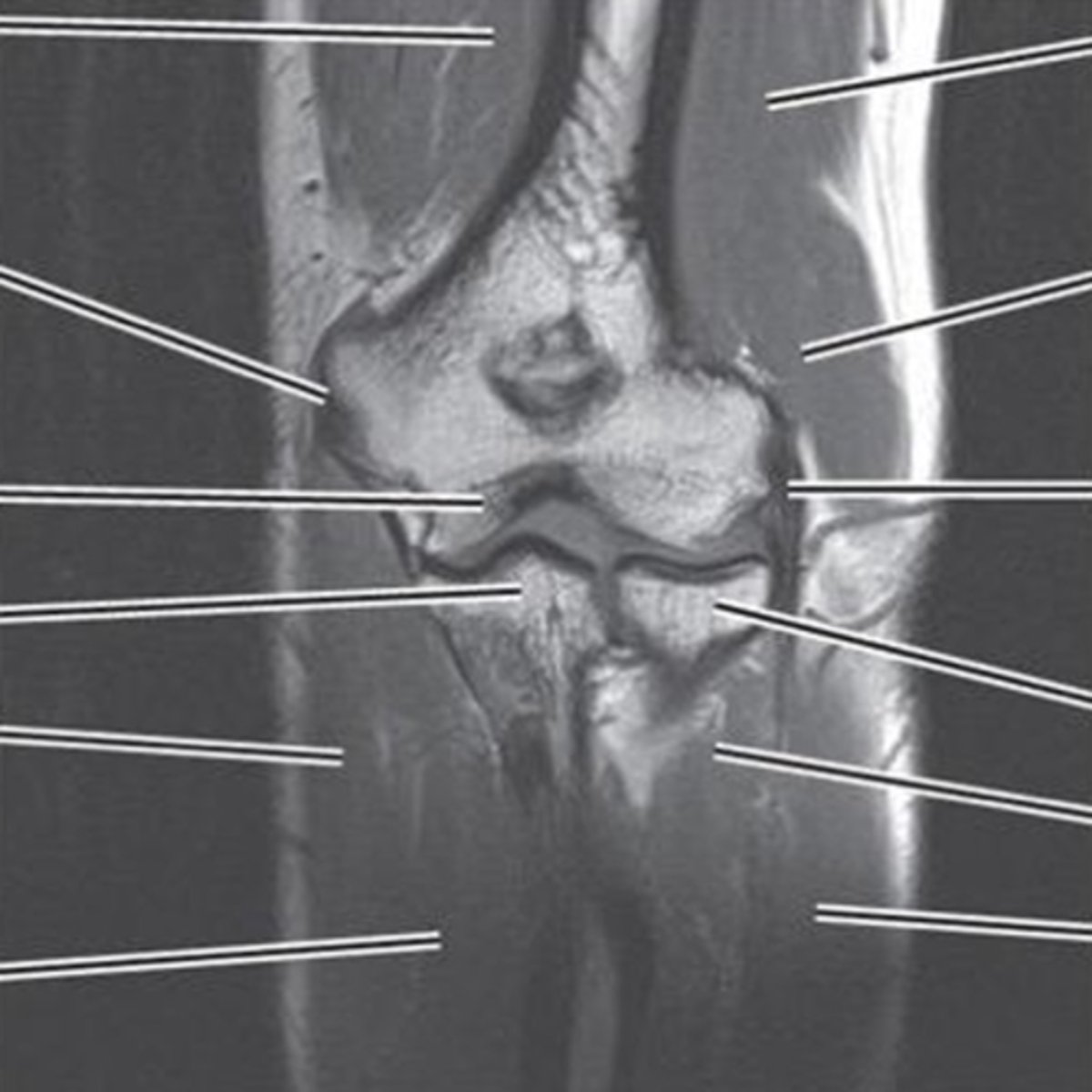 <p>- medial and lateral collateral ligaments<br>- common flexor and extensor tendons</p>