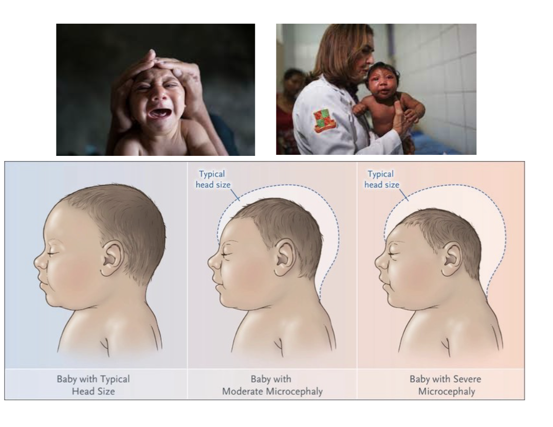 <ul><li><p>Started in Brazil in 2015. Spread by mosquitos. Can cause mild disease also Guillain-Barre (transient paralysis)</p></li><li><p> Virus can be passed to fetus. Causes birth defect (microcephaly)</p><p></p></li></ul><p></p>