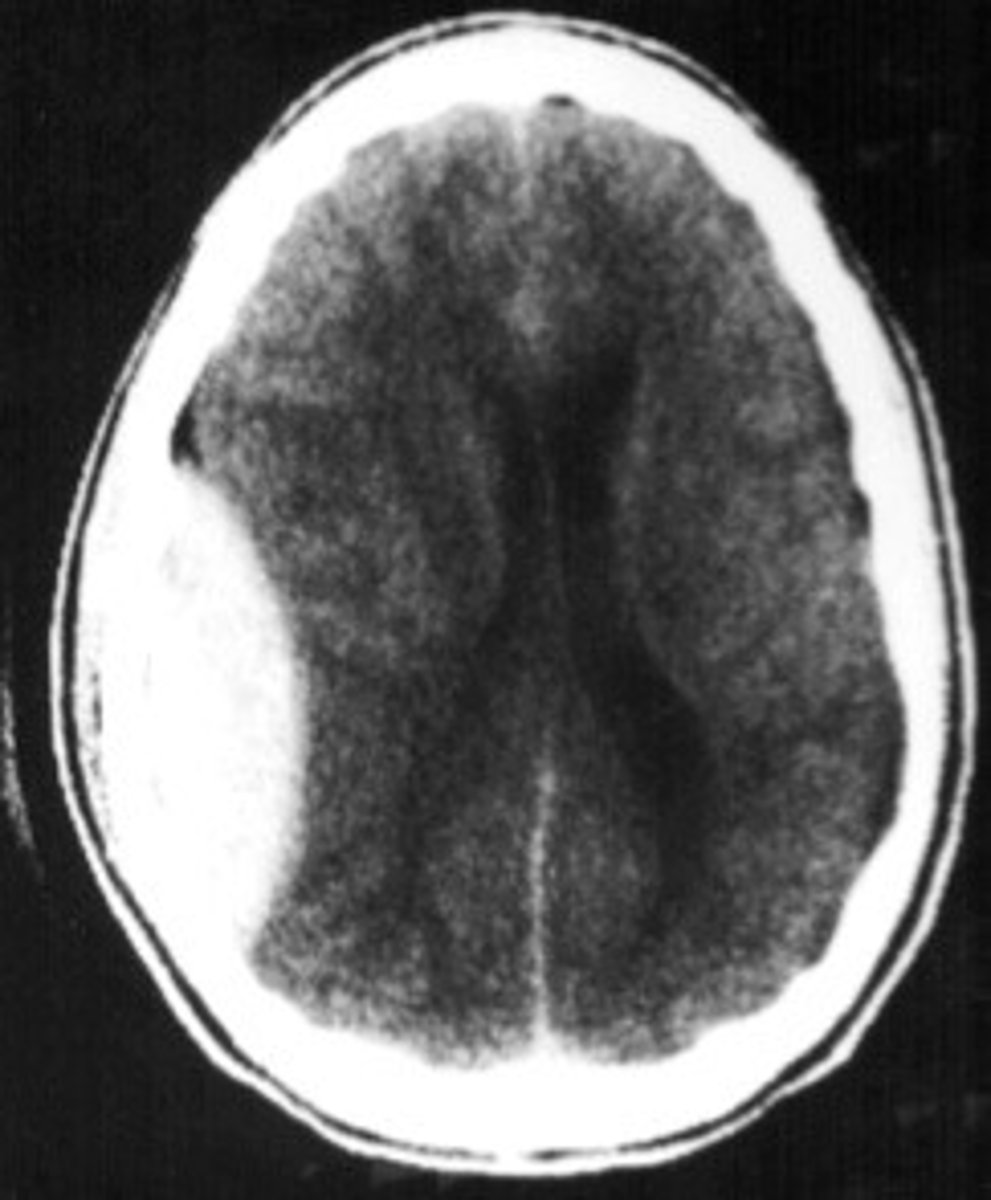 <p>- occurs with skull fracture which slices and ruptures the L/R middle meningeal artery - pressure from bleed separates dura from bone</p><p>- shows biconvex haemorrhage on x-ray because expansion of blood is contained by tight adherence of dura mater to skull</p><p>- treated with prompt surgical evacuation</p>