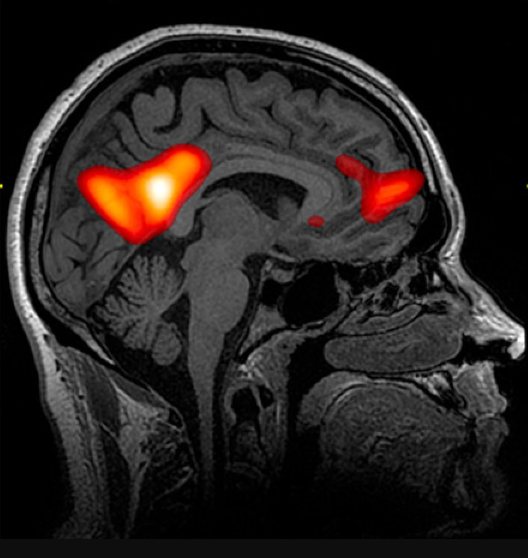 <ul><li><p>a technique for revealing bloodflow and brain activity by comparing successive MRI scans</p></li><li><p>shows brain function as well as structure</p></li></ul><p></p>